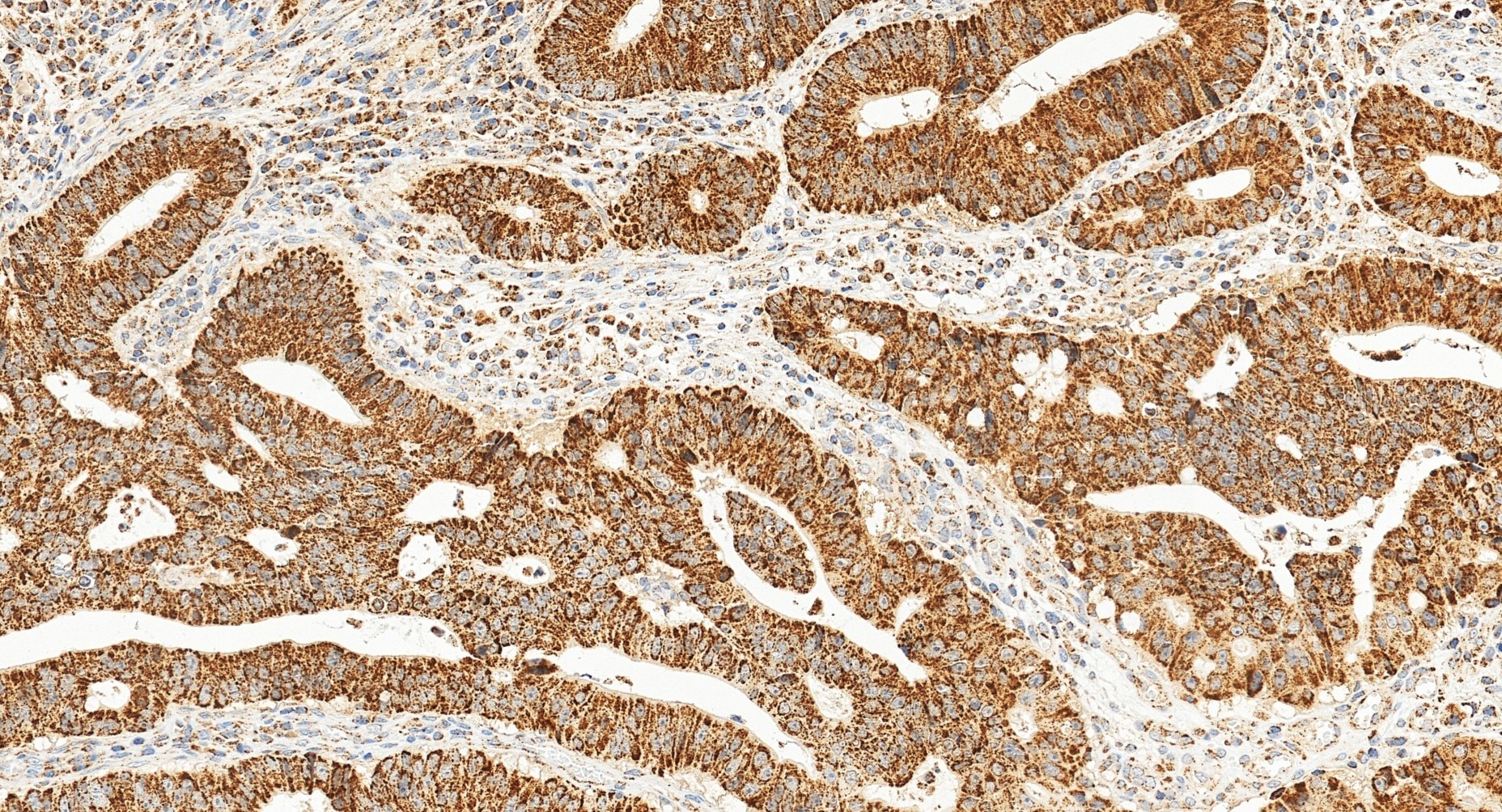 Immunohistochemical analysis of paraffin-embedded human colon cancer tissue slide using 22586-1-AP (TFAM antibody) at dilution of 1:2000 (under 20x lens). Heat mediated antigen retrieval with Tris-EDTA buffer (pH 9.0). Immunohistochemistry (IHC) staining of human colon cancer tissue using TFAM Polyclonal antibody (22586-1-AP)