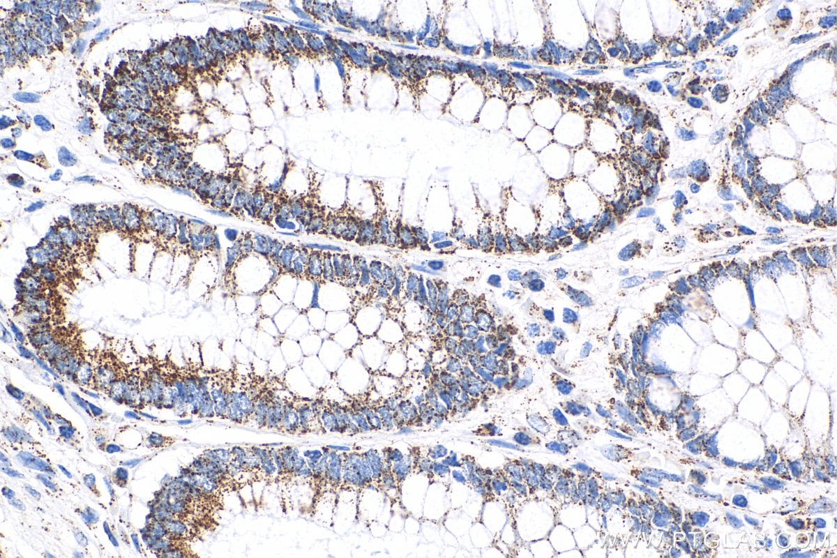 IHC staining of human colon cancer using 22586-1-AP