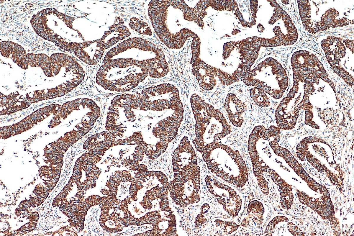 Immunohistochemistry (IHC) staining of human colon cancer tissue using TFAM Polyclonal antibody (22586-1-AP)