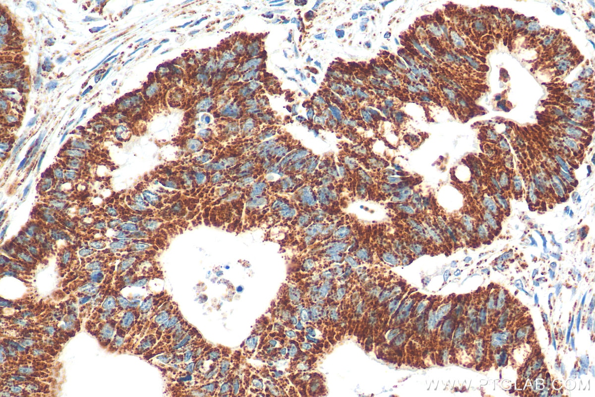 Immunohistochemistry (IHC) staining of human colon cancer tissue using TFAM Polyclonal antibody (22586-1-AP)