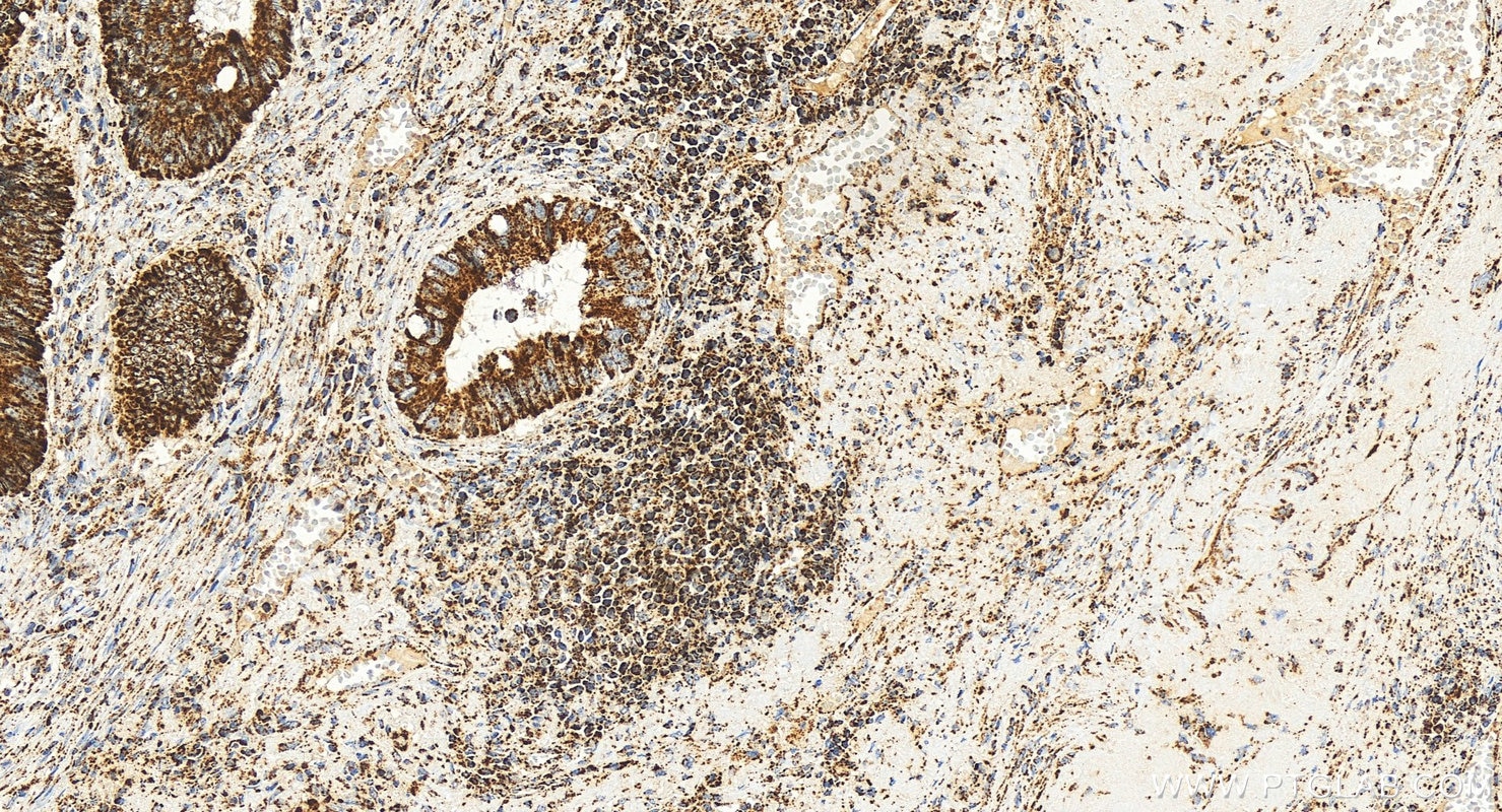 Immunohistochemistry (IHC) staining of human colon cancer tissue using TFAM Monoclonal antibody (68557-5-Ig)
