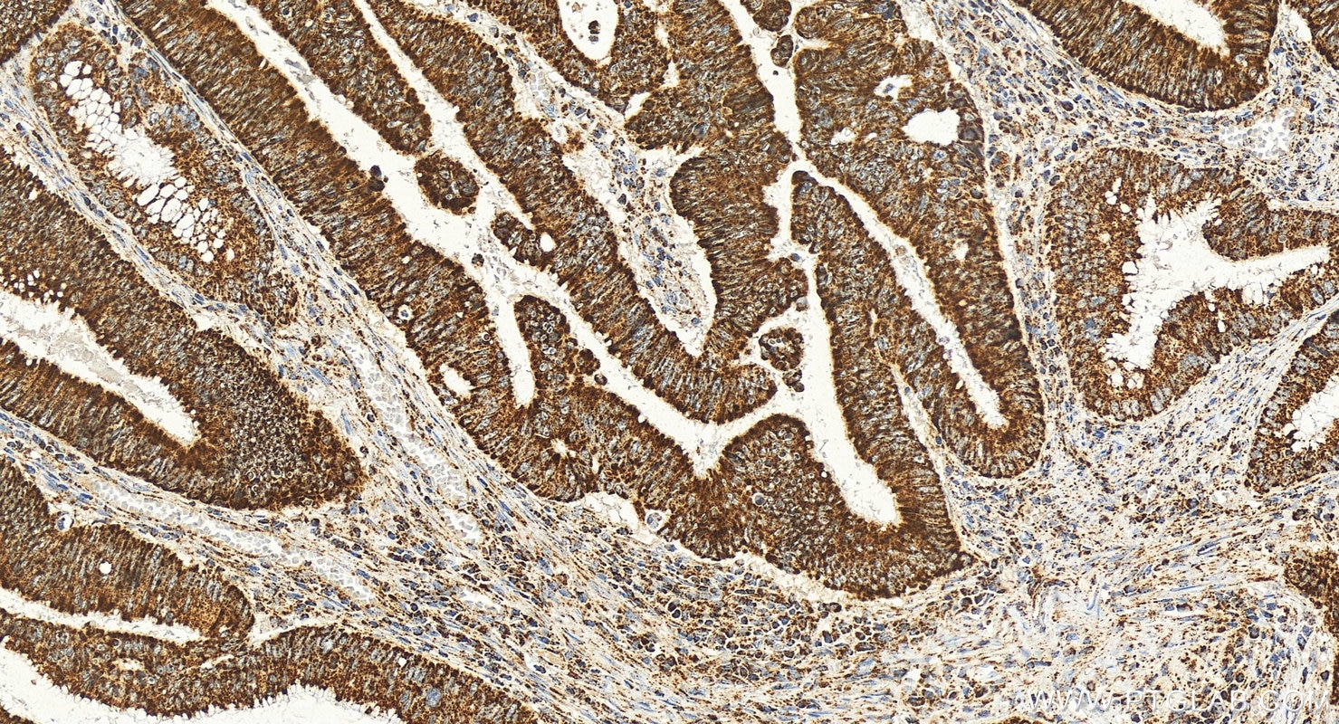 Immunohistochemistry (IHC) staining of human colon cancer tissue using TFAM Monoclonal antibody (68557-5-Ig)