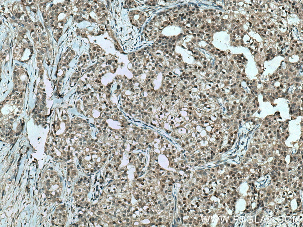 Immunohistochemistry (IHC) staining of human breast cancer tissue using TFAP2A,AP-2 Monoclonal antibody (67076-1-Ig)