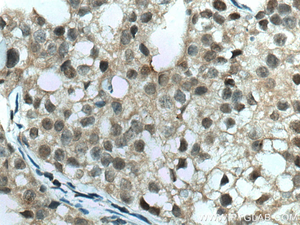 Immunohistochemistry (IHC) staining of human breast cancer tissue using TFAP2A/AP-2 Monoclonal antibody (67076-1-Ig)