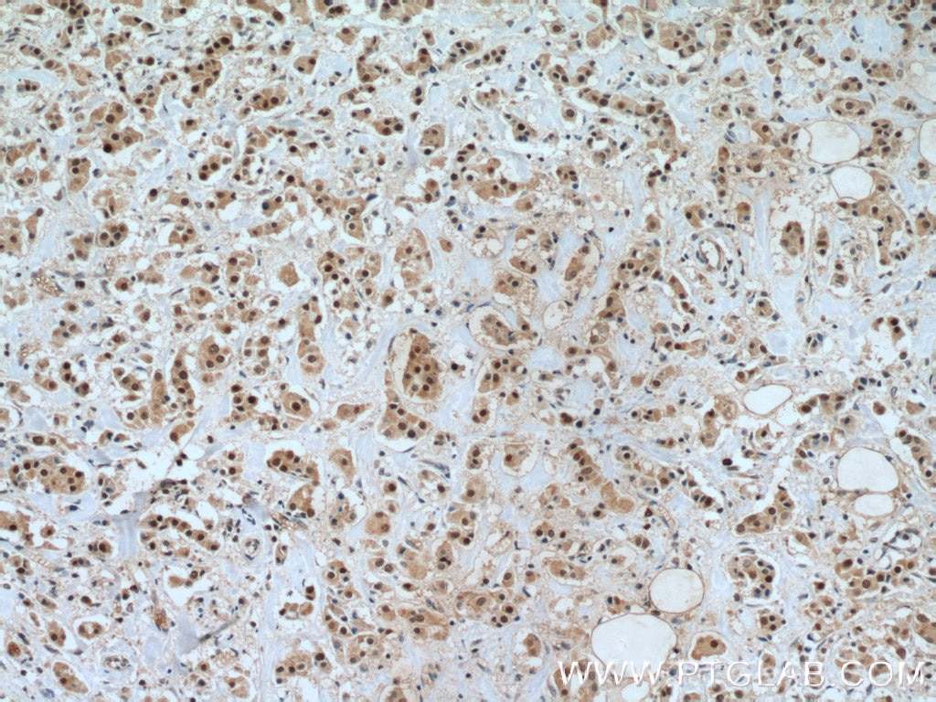IHC staining of human breast cancer using 14572-1-AP