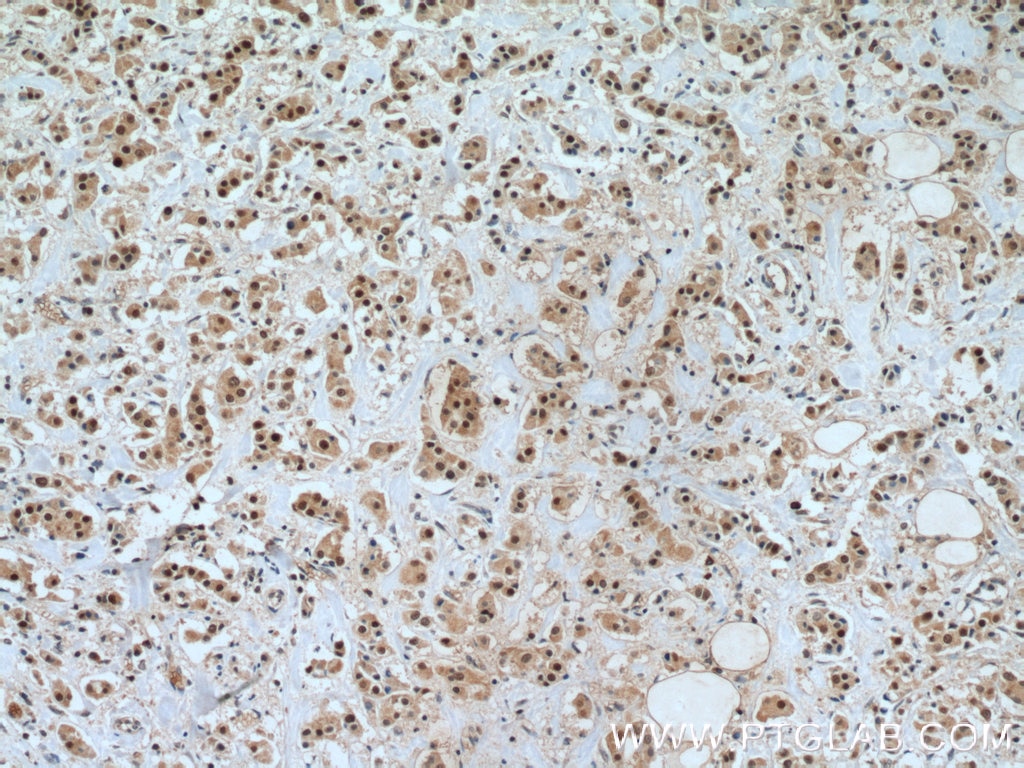 Immunohistochemistry (IHC) staining of human breast cancer tissue using TFAP2C Polyclonal antibody (14572-1-AP)