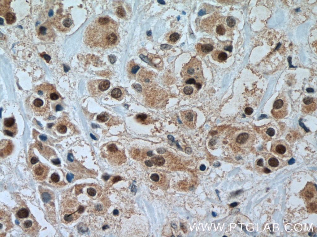 Immunohistochemistry (IHC) staining of human breast cancer tissue using TFAP2C Polyclonal antibody (14572-1-AP)