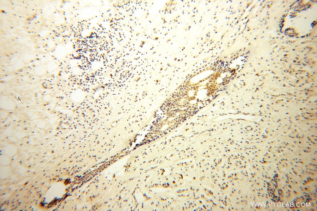 IHC staining of human breast cancer using 14572-1-AP