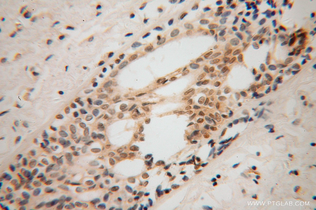 Immunohistochemistry (IHC) staining of human breast cancer tissue using TFAP2C Polyclonal antibody (14572-1-AP)