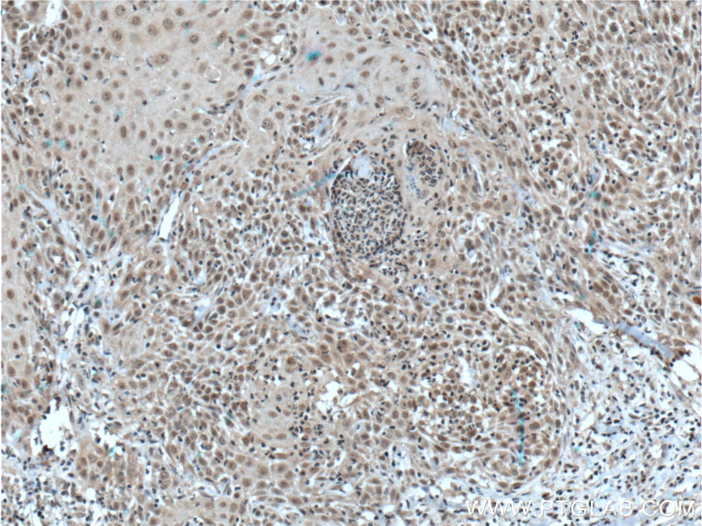 Immunohistochemistry (IHC) staining of human skin cancer tissue using TFAP2E Polyclonal antibody (25829-1-AP)