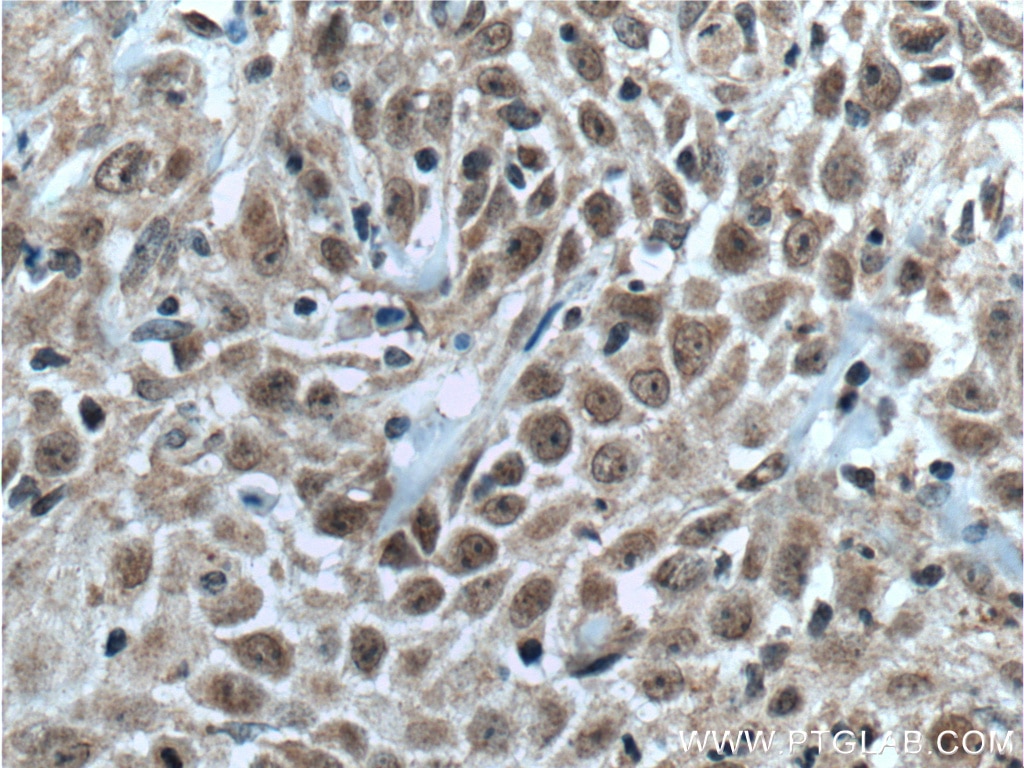 Immunohistochemistry (IHC) staining of human skin cancer tissue using TFAP2E Polyclonal antibody (25829-1-AP)