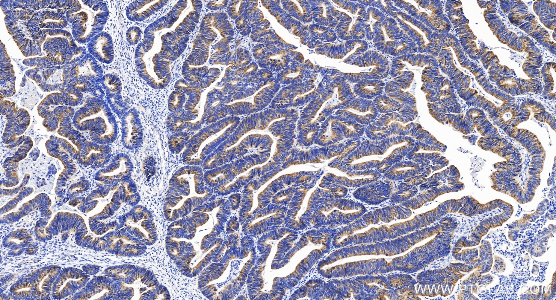 Immunohistochemistry (IHC) staining of human colon cancer tissue using TFB1M Recombinant antibody (84957-4-RR)