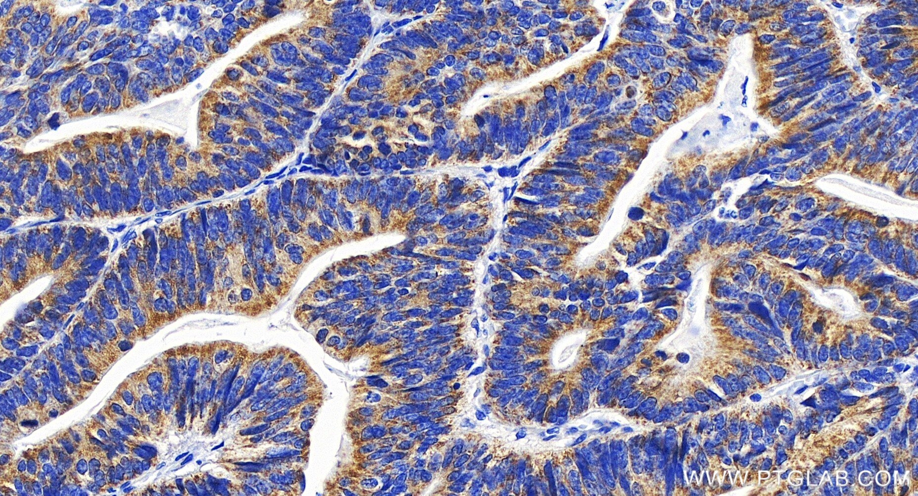 Immunohistochemistry (IHC) staining of human colon cancer tissue using TFB1M Recombinant antibody (84957-4-RR)