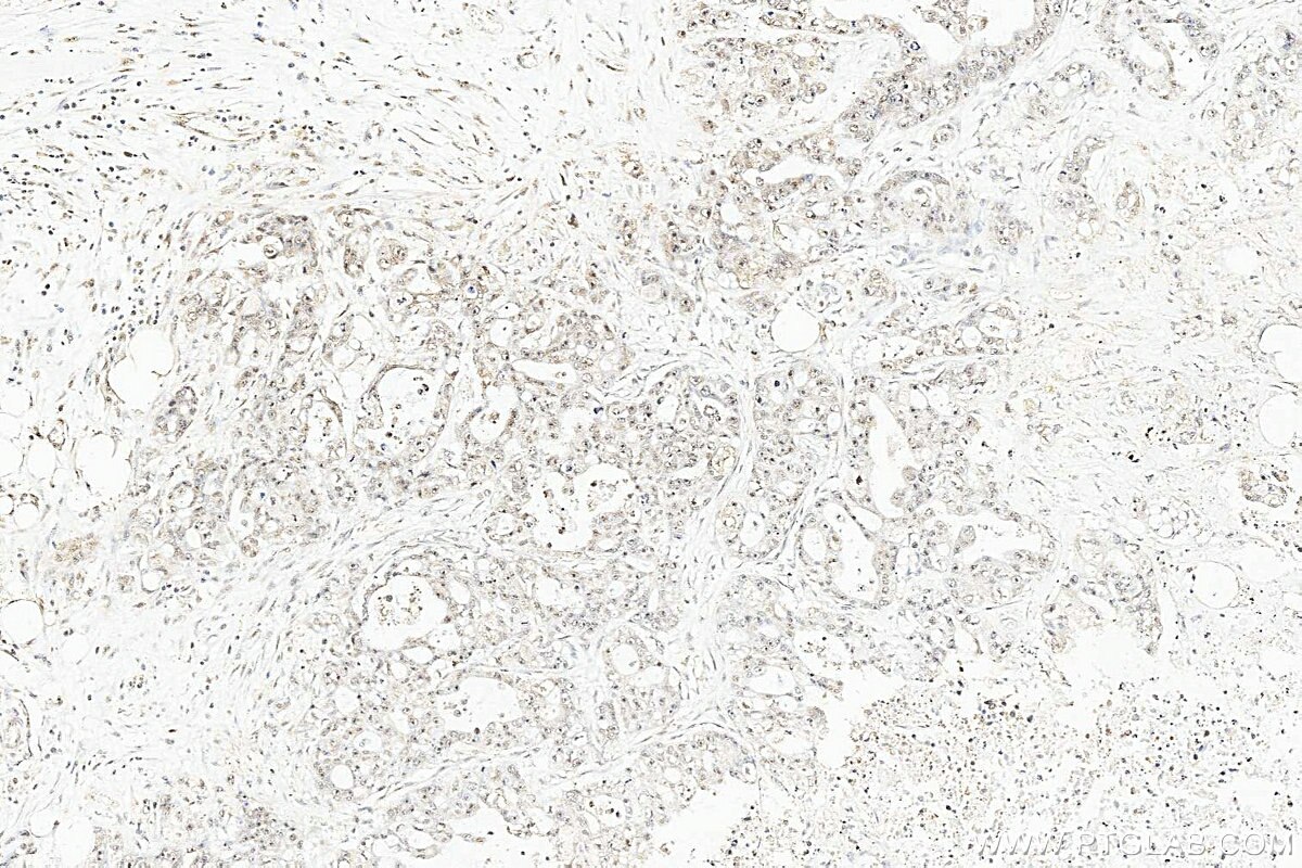 Immunohistochemistry (IHC) staining of human colon cancer tissue using TFDP1 Polyclonal antibody (11043-1-AP)