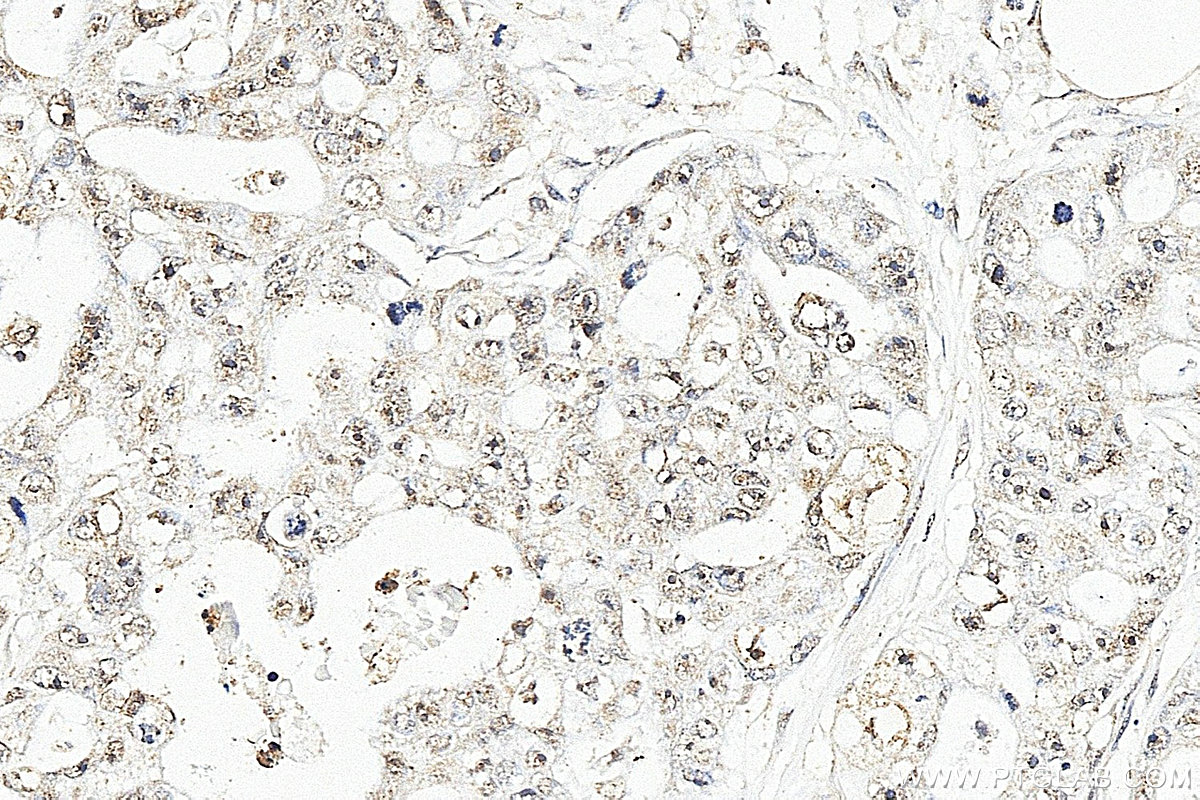 Immunohistochemistry (IHC) staining of human colon cancer tissue using TFDP1 Polyclonal antibody (11043-1-AP)