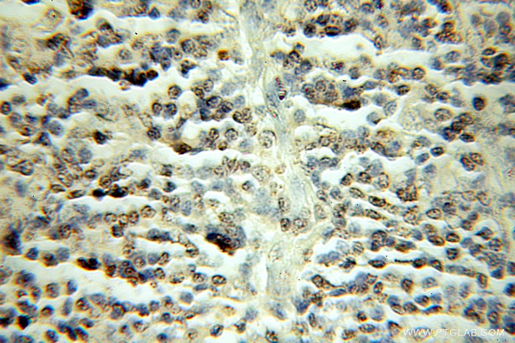 Immunohistochemistry (IHC) staining of human lymphoma tissue using TFDP1 Polyclonal antibody (11043-1-AP)