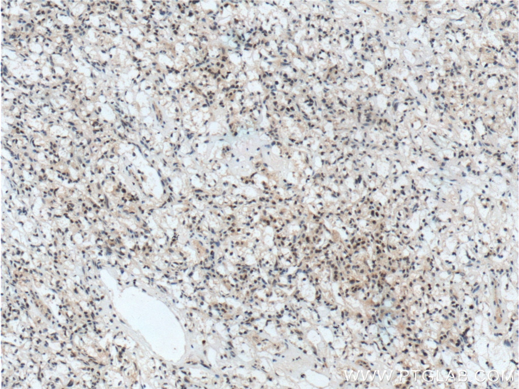 Immunohistochemistry (IHC) staining of human renal cell carcinoma tissue using TFE3 Polyclonal antibody (14480-1-AP)