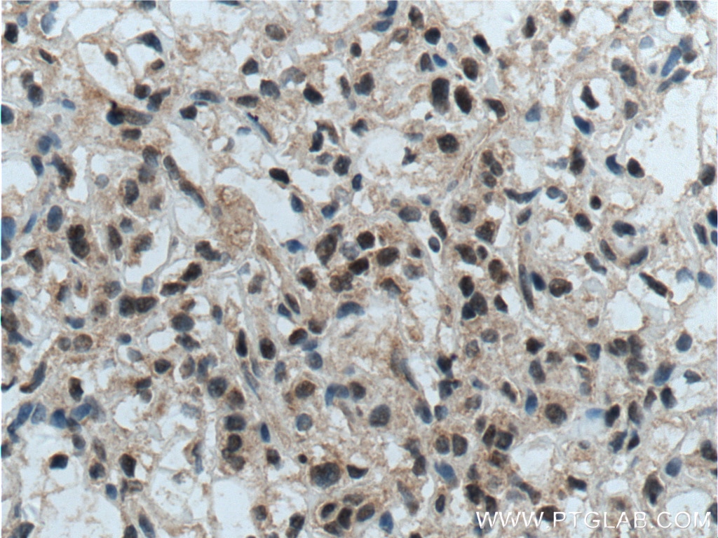 Immunohistochemistry (IHC) staining of human renal cell carcinoma tissue using TFE3 Polyclonal antibody (14480-1-AP)