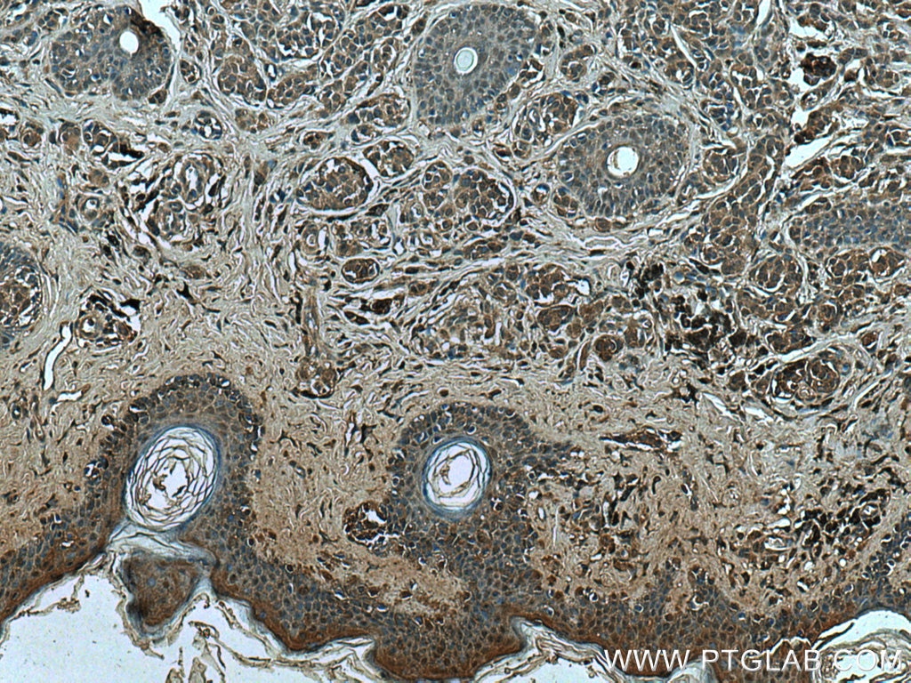 Immunohistochemistry (IHC) staining of human malignant melanoma tissue using TFE3 Monoclonal antibody (67319-1-Ig)