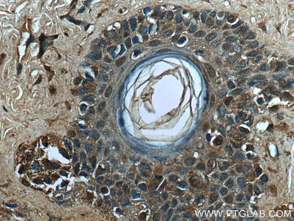 Immunohistochemistry (IHC) staining of human malignant melanoma tissue using TFE3 Monoclonal antibody (67319-1-Ig)