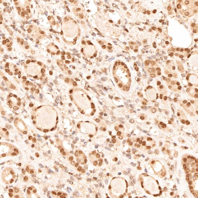 Immunohistochemistry (IHC) staining of human renal cell carcinoma tissue using TFE3 Monoclonal antibody (67319-1-Ig)
