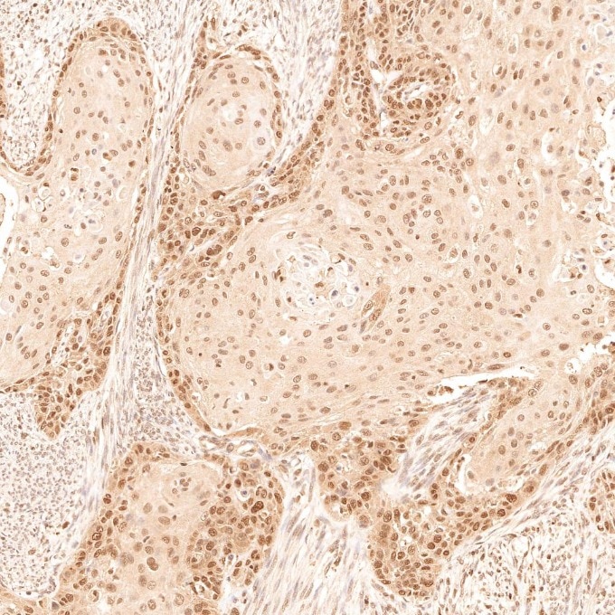 IHC staining of human cervical cancer using 67319-1-Ig (same clone as 67319-1-PBS) Immunohistochemistry (IHC) staining of human cervical cancer tissue using TFE3 Monoclonal antibody (67319-1-Ig)