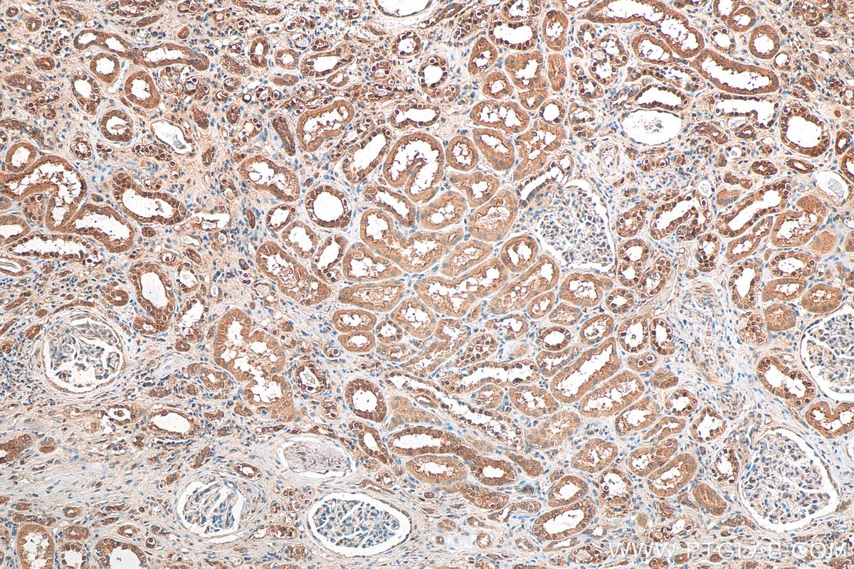 Immunohistochemistry (IHC) staining of human renal cell carcinoma tissue using TFEB Polyclonal antibody (13372-1-AP)