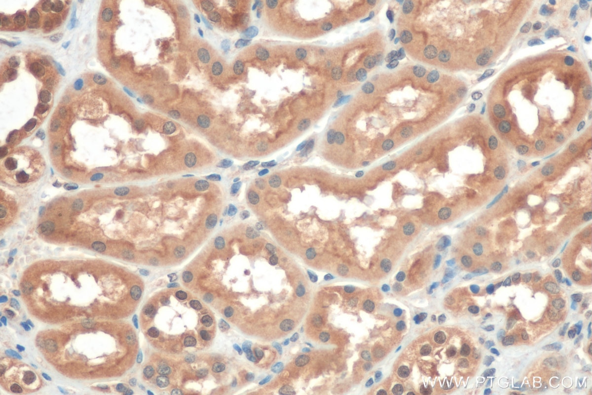IHC staining of human renal cell carcinoma using 13372-1-AP
