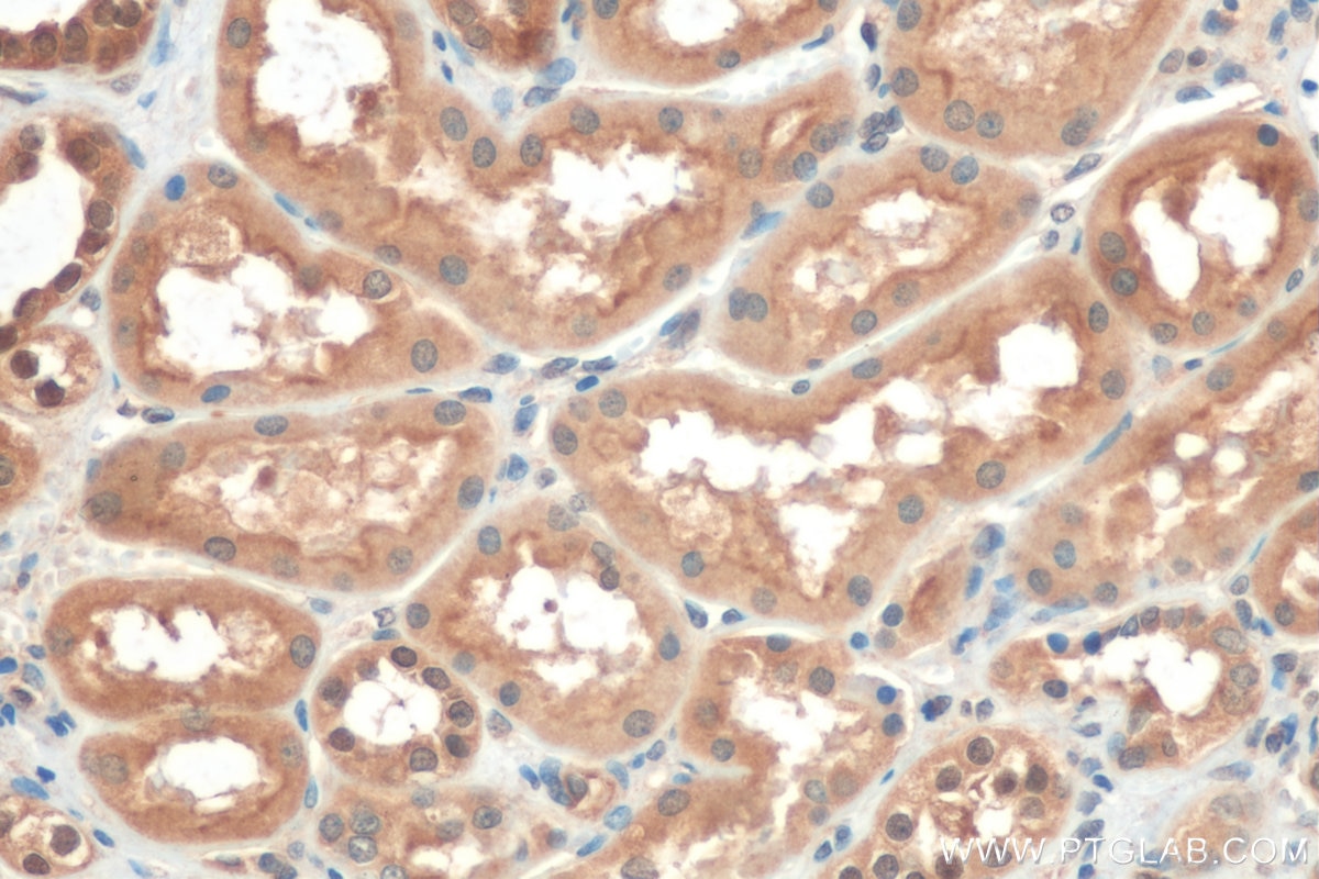 Immunohistochemistry (IHC) staining of human renal cell carcinoma tissue using TFEB Polyclonal antibody (13372-1-AP)