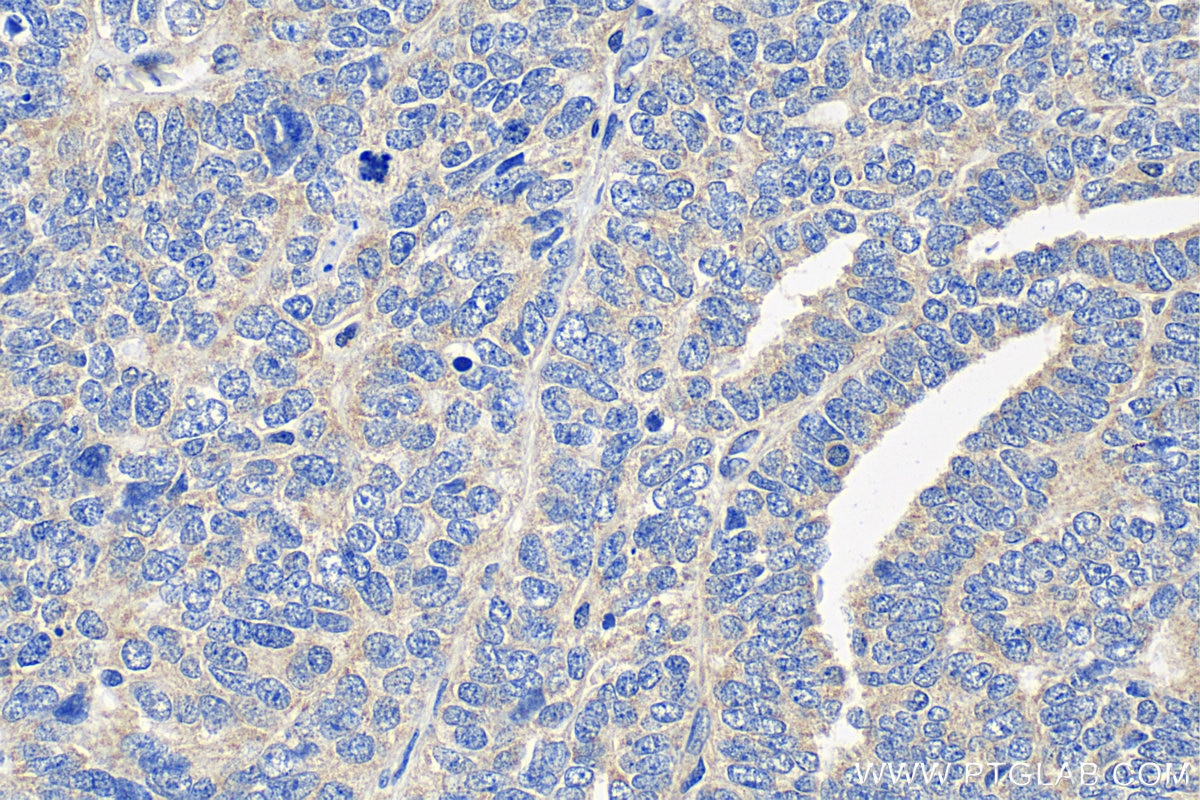 IHC staining of human ovary tumor using 13734-1-AP