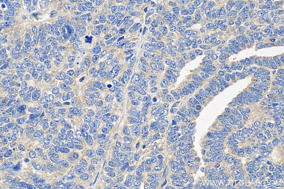 Immunohistochemistry (IHC) staining of human ovary tumor tissue using TFF1 Polyclonal antibody (13734-1-AP)