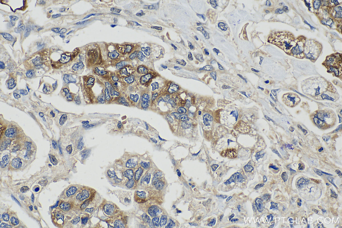 Immunohistochemistry (IHC) staining of human stomach cancer tissue using Trefoil factor 1 Polyclonal antibody (13734-1-AP)