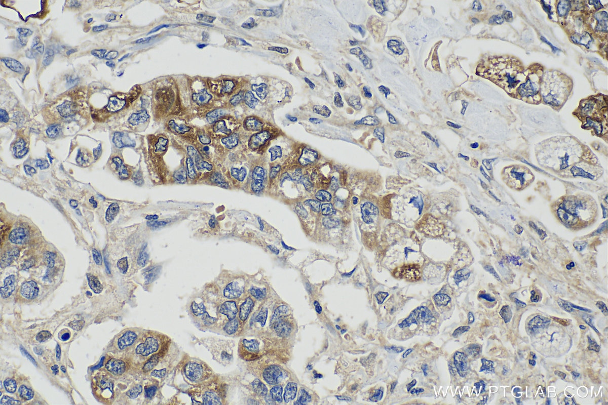 Immunohistochemistry (IHC) staining of human stomach cancer tissue using TFF1 Polyclonal antibody (13734-1-AP)