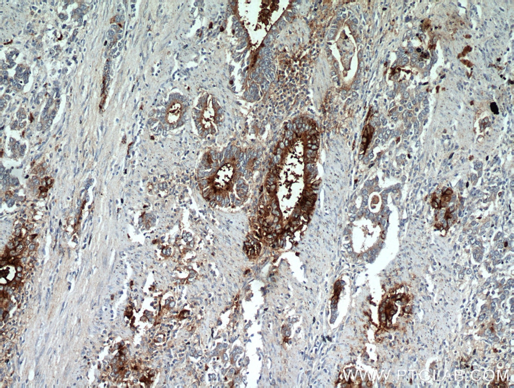 Immunohistochemistry (IHC) staining of human stomach cancer tissue using TFF2 Polyclonal antibody (13681-1-AP)