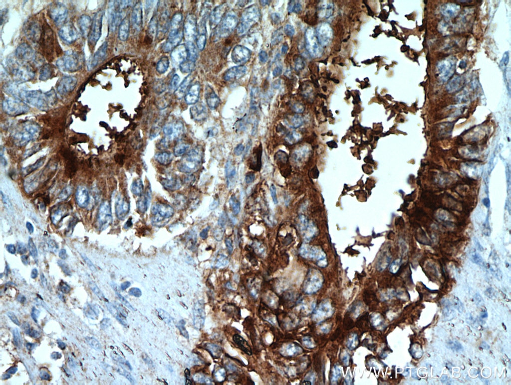 Immunohistochemistry (IHC) staining of human stomach cancer tissue using TFF2 Polyclonal antibody (13681-1-AP)