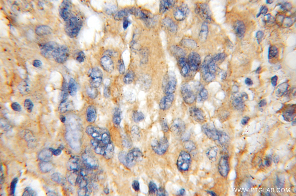 Immunohistochemistry (IHC) staining of human gliomas tissue using TFG Polyclonal antibody (11571-1-AP)