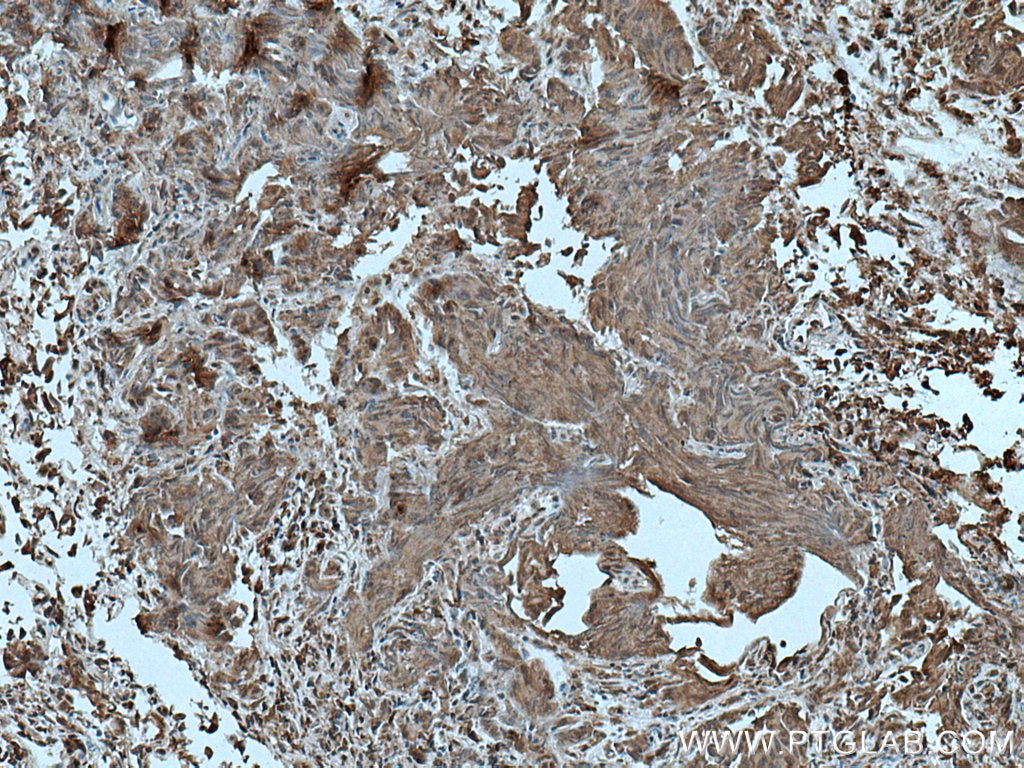 Immunohistochemistry (IHC) staining of human prostate cancer tissue using TFG Monoclonal antibody (66916-1-Ig)