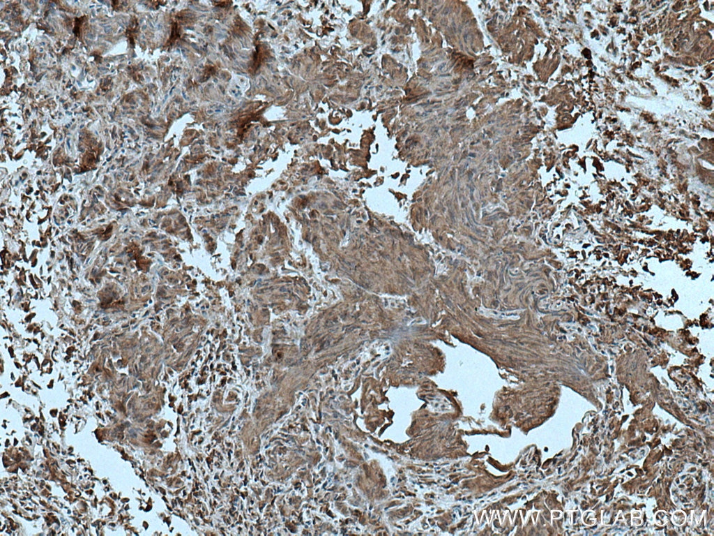 IHC staining of human prostate cancer using 66916-1-Ig