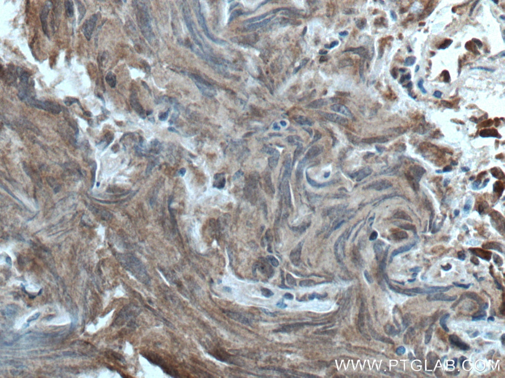 Immunohistochemistry (IHC) staining of human prostate cancer tissue using TFG Monoclonal antibody (66916-1-Ig)