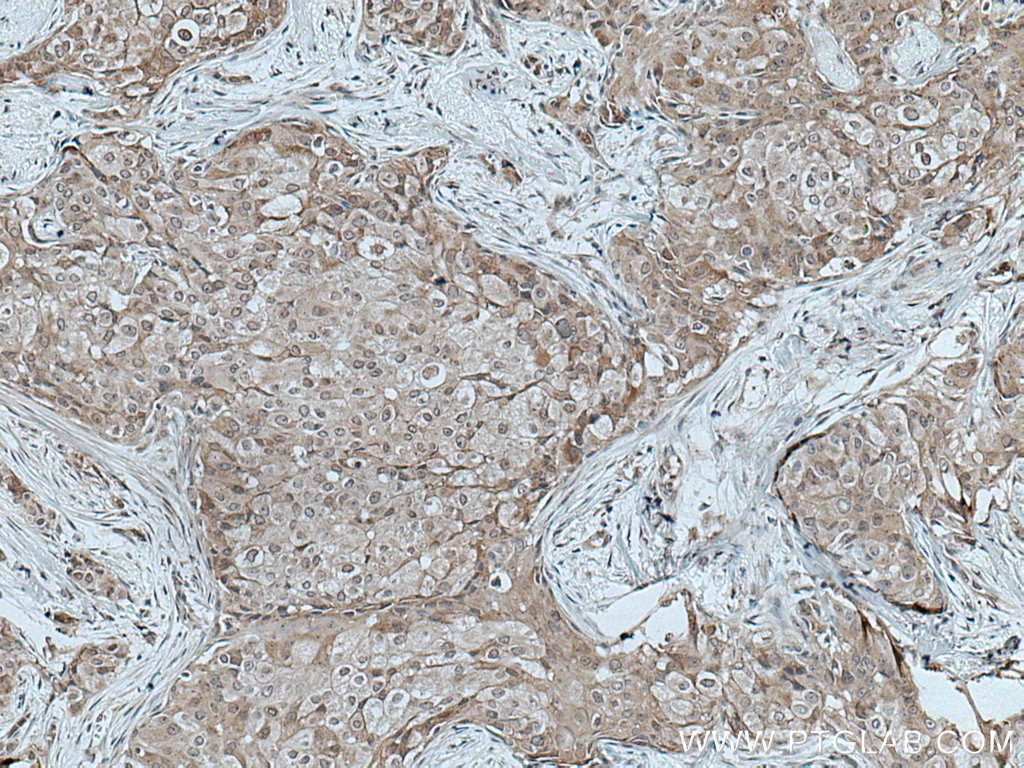 Immunohistochemistry (IHC) staining of human breast cancer tissue using TFG Monoclonal antibody (66916-1-Ig)