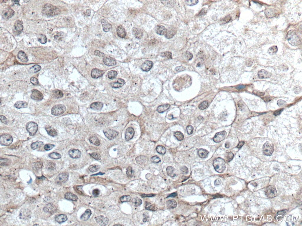 Immunohistochemistry (IHC) staining of human breast cancer tissue using TFG Monoclonal antibody (66916-1-Ig)