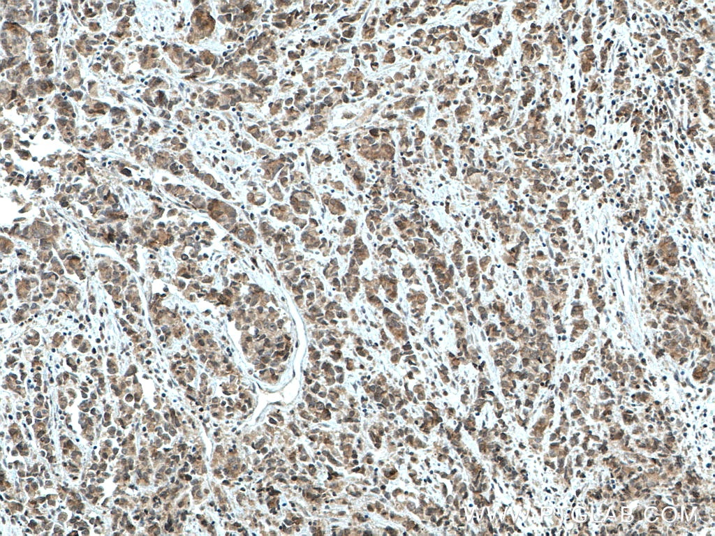 Immunohistochemistry (IHC) staining of human prostate cancer tissue using TFIP11 Monoclonal antibody (66114-1-Ig)