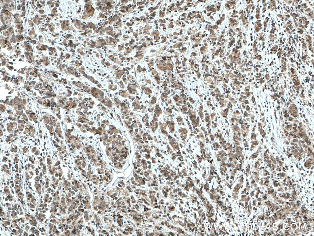 IHC staining of human prostate cancer using 66114-1-Ig