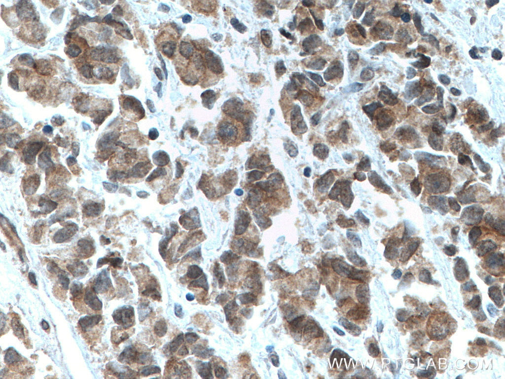 Immunohistochemistry (IHC) staining of human prostate cancer tissue using TFIP11 Monoclonal antibody (66114-1-Ig)