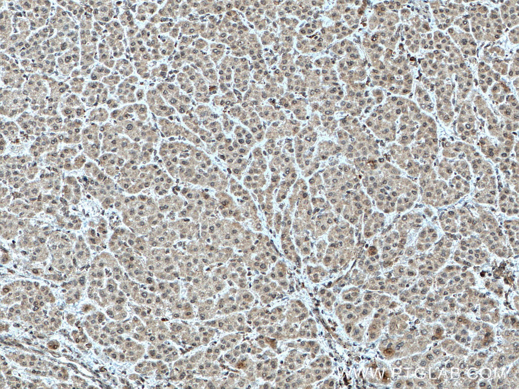 Immunohistochemistry (IHC) staining of human liver cancer tissue using TFIP11 Monoclonal antibody (66114-1-Ig)