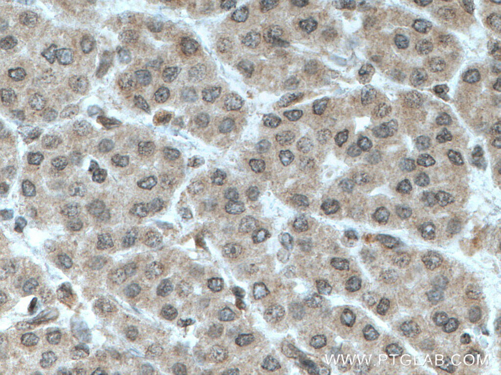 IHC staining of human liver cancer using 66114-1-Ig