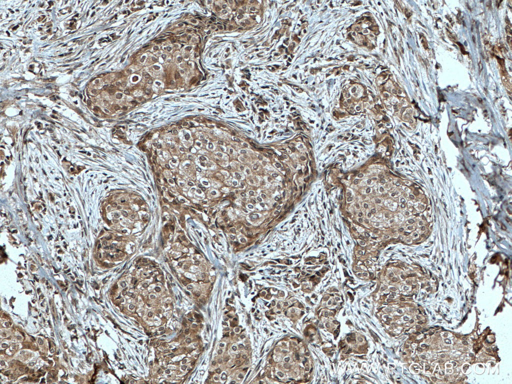 Immunohistochemistry (IHC) staining of human breast cancer tissue using TFIP11 Monoclonal antibody (66114-1-Ig)