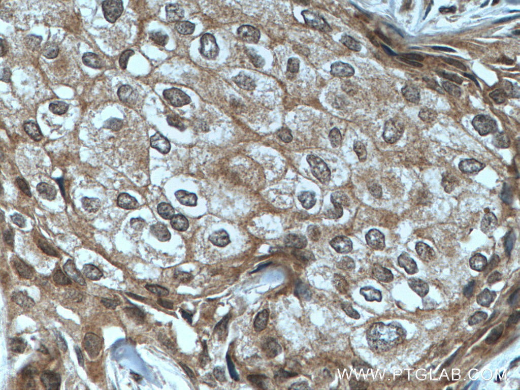 Immunohistochemistry (IHC) staining of human breast cancer tissue using TFIP11 Monoclonal antibody (66114-1-Ig)