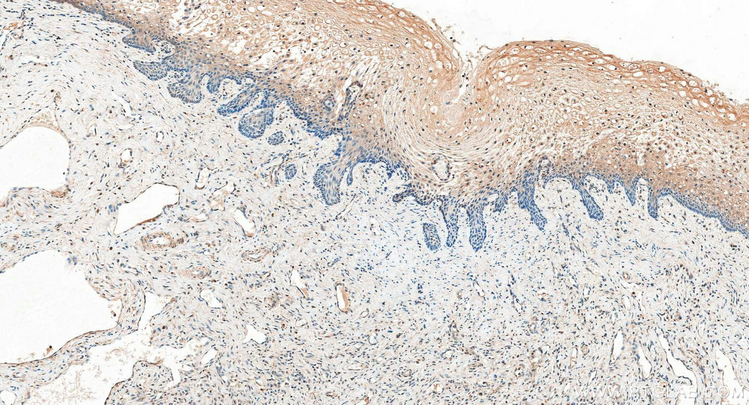 Immunohistochemistry (IHC) staining of human cervical cancer tissue using TFPI2 Polyclonal antibody (30689-1-AP)