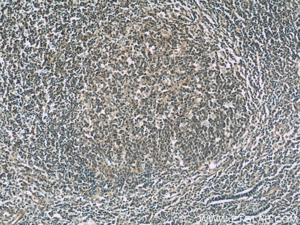 Immunohistochemistry (IHC) staining of human tonsillitis tissue using TFPT Polyclonal antibody (10097-2-AP)